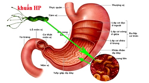 Vi khuẩn HP là nguyên nhân chính khiến bạn bị viêm loét Dạ dày - Tá tràng