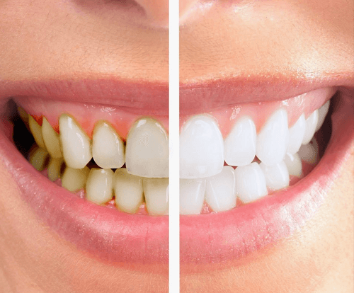 Bút tẩy trắng răng Dazzling White ngay lập tức loại bỏ vôi răng, mảng bám ố vàng trên răng dễ dàng