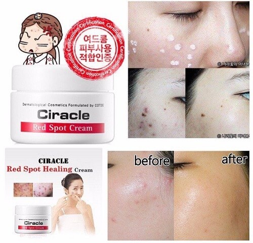 Kem trị mụn Ciracle Red Spot Cream trả lại cho bạn làn da sạch mụn, trắng sáng