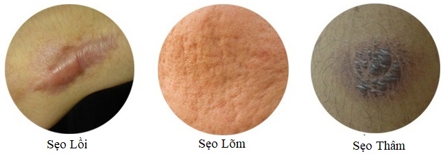 Kem trị sẹo Scar Esthetique