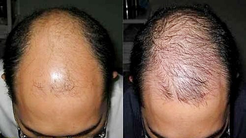 Thuốc mọc tóc Minoxidil Kirkland chứa thành phần an toàn cho người sử dụng